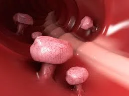 Pólipo intestinal