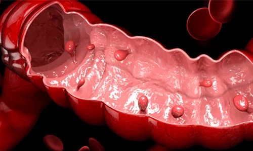 Pólipos Intestinais