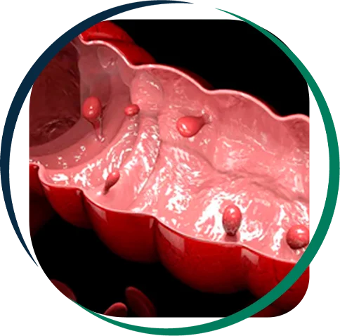 Pólipos Intestinais
