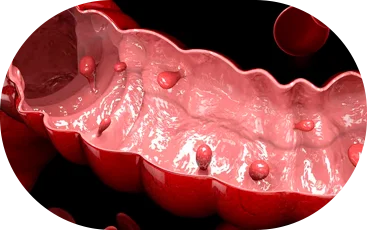 Pólipos Intestinais